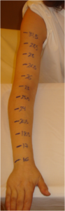 Las técnicas combinadas dan buen resultado en el tratamiento del linfedema. 